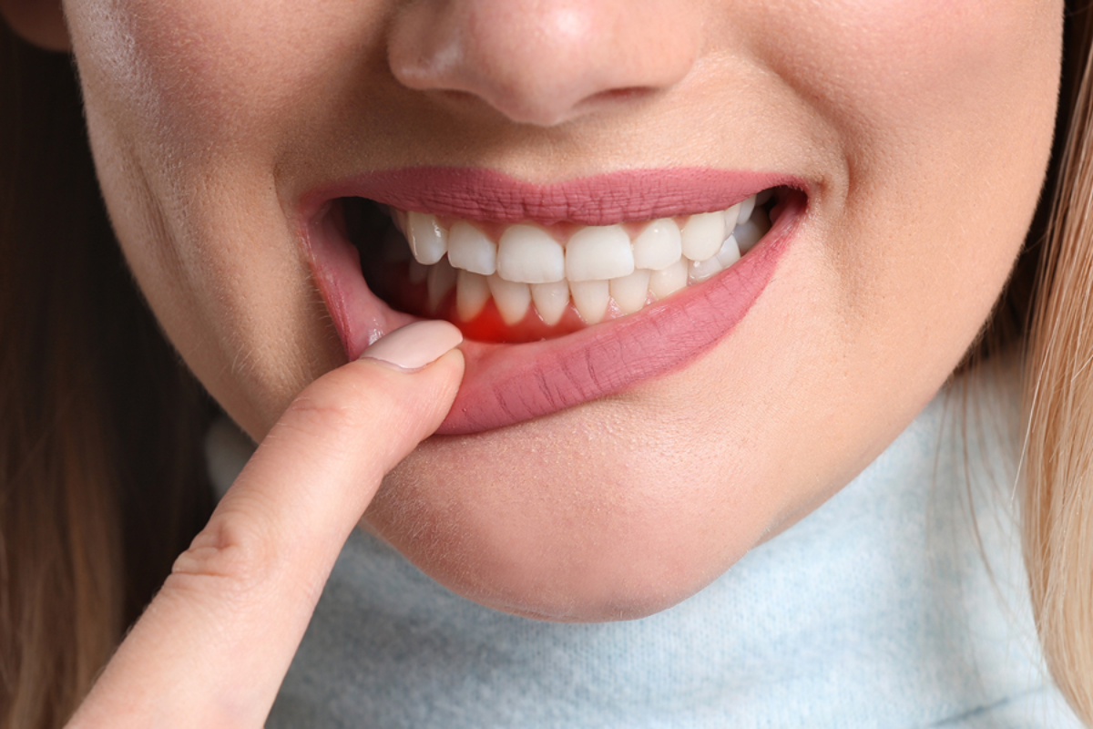 Gummy Smile Reduction