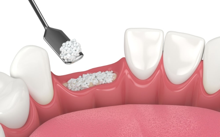 About Bone Grafting