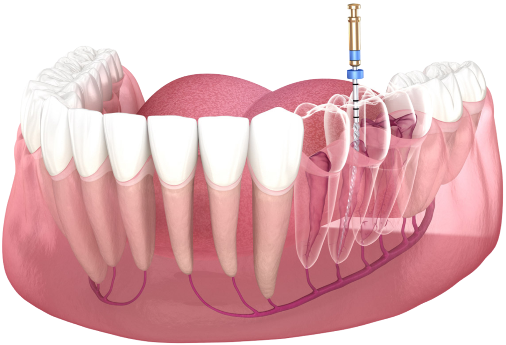 root canal treatment in richmond