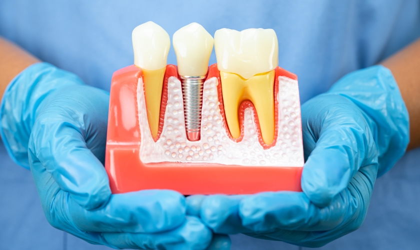 dental implants in Richmond